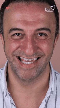 DentX International — Smile Transformation (AI Morphing & Before/After)